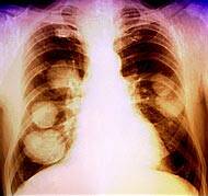 La mortalidad por cáncer de pulmón aumenta entre las mujeres