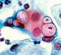 EEUU alerta por la aparición de casos de «superbacterias» de gonorrea