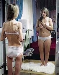 La anorexia es el trastorno psicológico con mayor índice de mortalidad en España