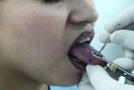 Los ‘piercings’ orales causan lesiones bucodentales la mayoría de las veces